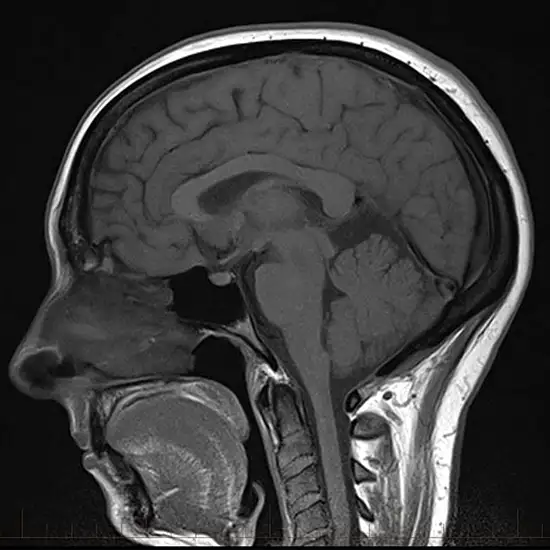 MRI Screening Of Brain